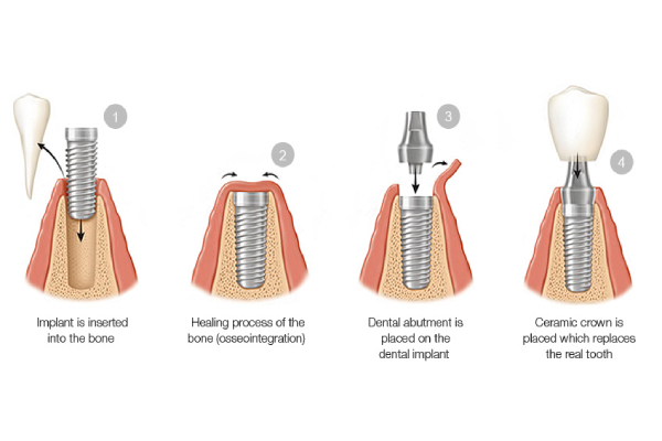 Dental Implant Procedure